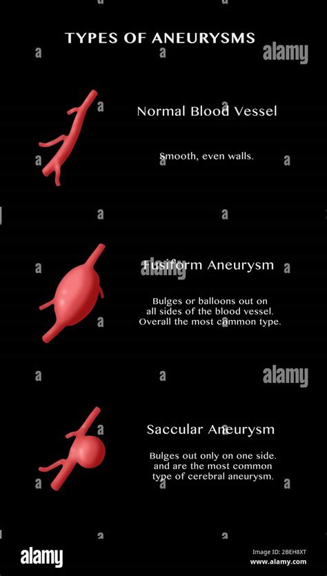 Middle Cerebral Artery Hi Res Stock Photography And Images Alamy