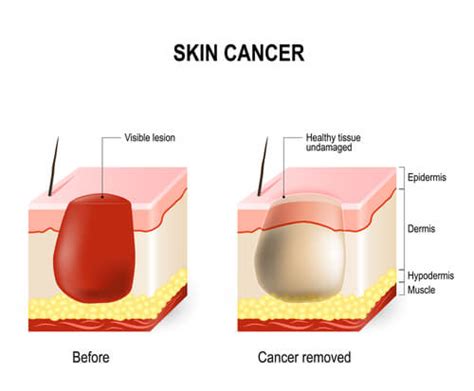 Skin Cancer Screening in Illinois | Dermatology Associates