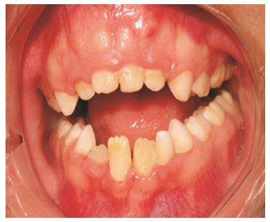 Cleidocranial Dysplasia Intraoral