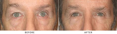 Upper Lid Blepharoplasty Before and After Photo Gallery