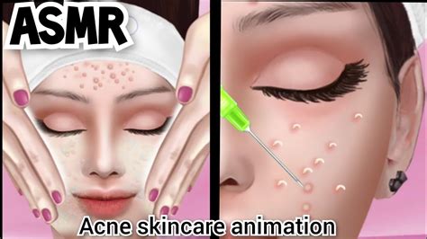 Asmr 팅글 주의 여드름 피부 관리 애니메이션 여드름 압출 Acne Removal Skin Care Acne