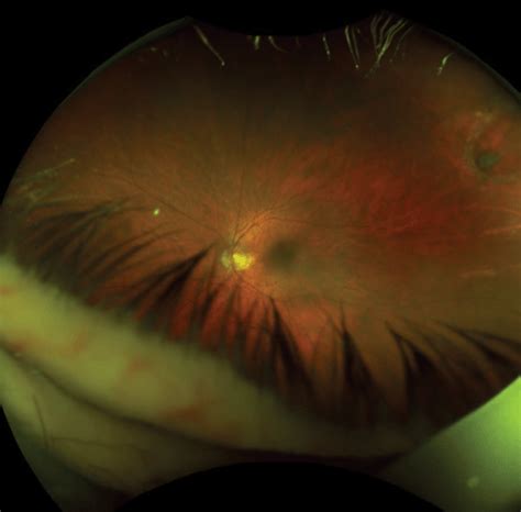 Posterior Vitreous Detachment How To Approach Sudden Onset Floaters And ...