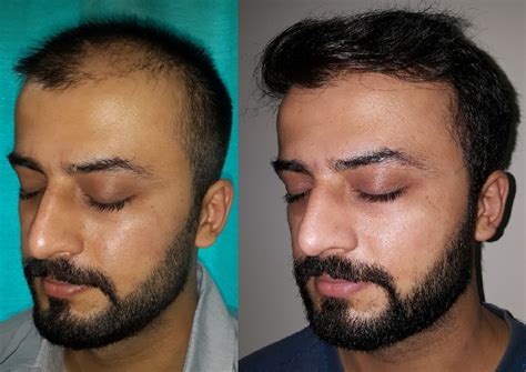 Top Hair Transplant Surgery Near Me In Rajapuri Hair Transplant