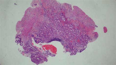 Histopathology Of The Biopsy From The Gastric Perforation Showing Near Download Scientific