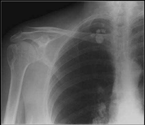 Calcified Hilar Lymph Nodes