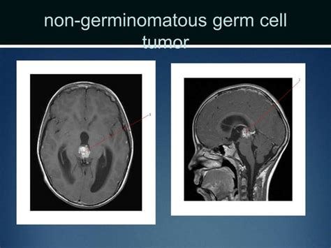 Pineal Tumors PPT