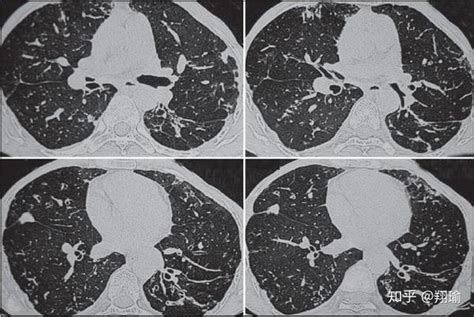 基于深度学习的肺纤维化疾病高分辨率ct自动分类 知乎