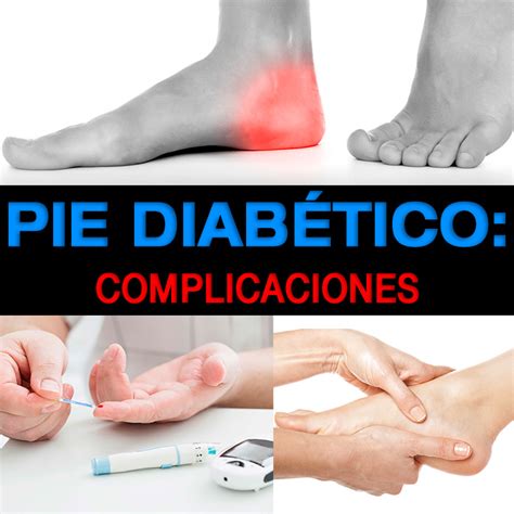 Complicaciones del pie diabético y cómo prevenirlas La Guía de las