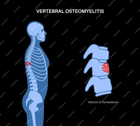 Osteomielite Vertebral Infectado Sequestro De Ossos Da Coluna Vertebral