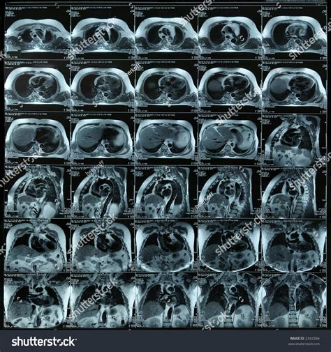 Chest Mri Foto Stock Shutterstock