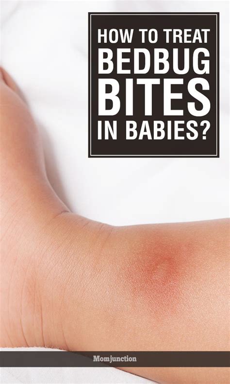 How To Treat Bedbug Bites On Babies