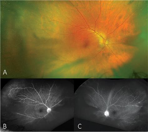 A, Fundus photograph of the right eye demonstrates optic nerve edema ...