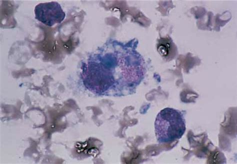 Figure 1 From Hemophagocytic Syndrome In A Patient With Hashimotos