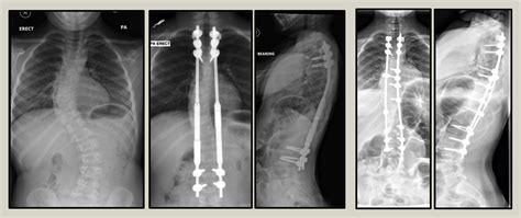 Early Onset Scoliosis Clinical Presentation Assessment And Treatment