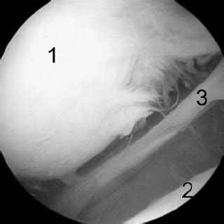 Retinacular bands visualized after complete excision of the plica. 1 ...