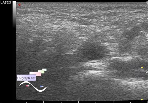 Scrotum Hydrocele Scrotum Sonography Clinical Report Video Images