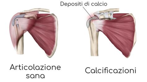 Calcificazione Della Spalla Fisioterapia E Riabilitazione A Roma