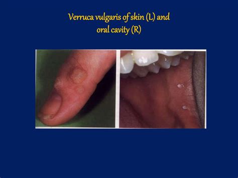 Benign Tumors Of Epithelial Origin Of Oral Cavity PPT