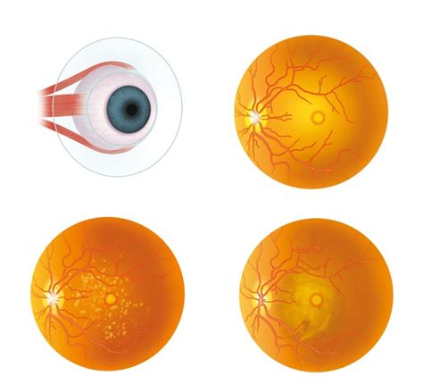 17 Cystoid Macular Edema Royalty-Free Photos and Stock Images ...