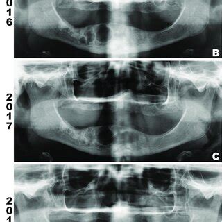 A Panoramic Radiograph Evidenced Intimate Relationship Between Central