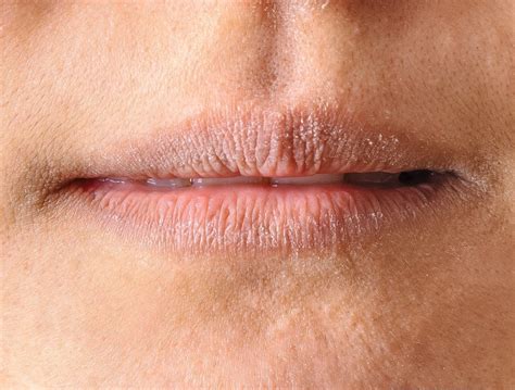 Lip Licker S Eczema Dermatitis Medical Secrets