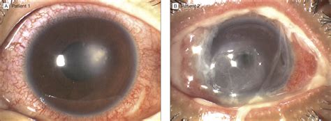 An Outbreak Of Fusarium Keratitis Associated With Contact Lens Wear In Singapore Cornea Jama