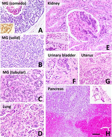 Intermediate Grade Mammary Gland Adenocarcinoma In An 18 Year Old