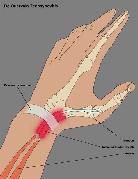 De Quervain Tenosynovitis Article