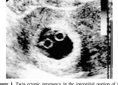 Figure 1 From Uterine Artery Embolization For Management Of