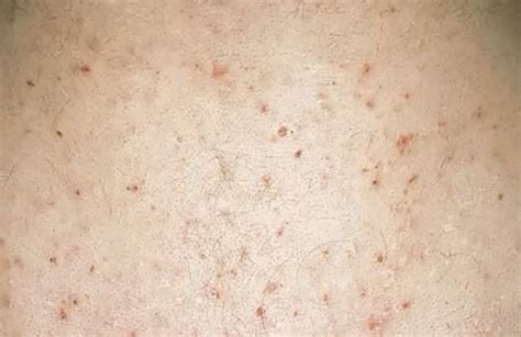 Pruritic Papules Pictures Photos