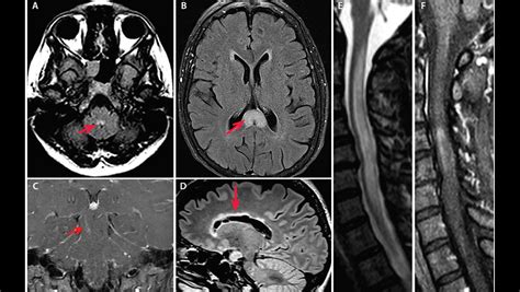 Nmosd Lesions The Neurology Hub