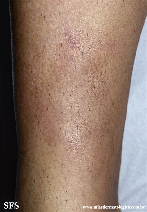 Granuloma Annulare Subcutaneous Nc Commons