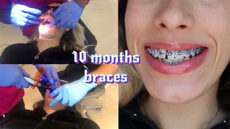 Braces Update Vlog First Time Getting Colored Elastics For My Damon