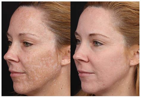 Laser Skin Center And Medical Spa Cosmelan Md Peel