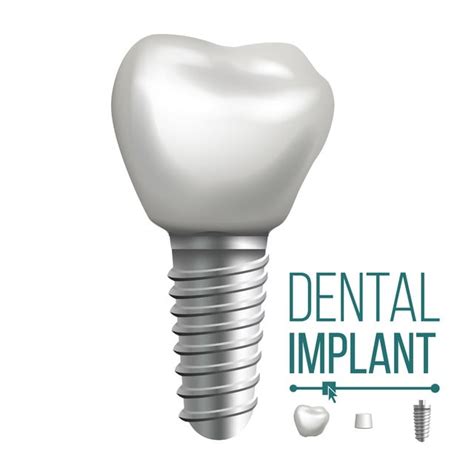 Teeth Dental Implants Vector Hd Images Dental Implant Vector Molar