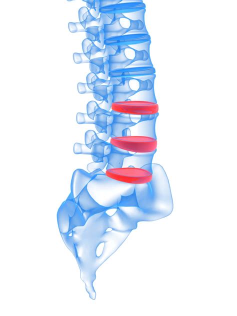 Cervical Spinal Fusion - Atlanta Brain and Spine Care