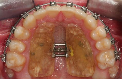 Palatal Expander Center For Orthodontic Excellence Princeton