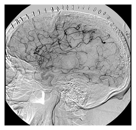 Carotid Cerebral Angiogram Right Internal Carotid Artery Injection