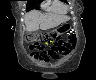 Subtotal Colectomy with Ileostomy, Surgical Management of Ischemic ...