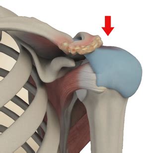 Subacromial Decompression Montgomery AL Shoulder Impingement