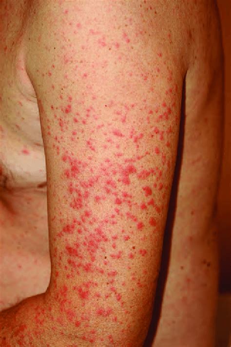 Maculopapular Rash