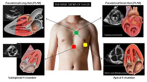 Introduction To Focused Cardiac Ultrasound The Parasternal Long Axis