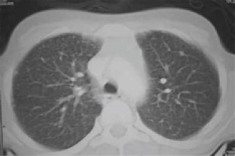 Ct Scan Of The Chest Multiple Miliary Shadows In Both Lung Fi Elds