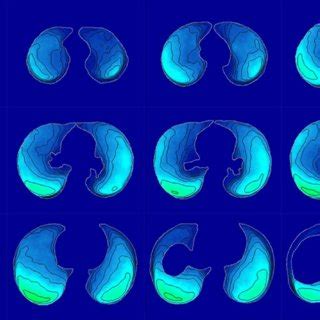 Pulmonary Lesion Distribution Is Atlas Displayed By Heat Map Overlaid