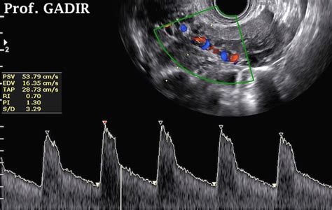 Doppler In Gynaecology