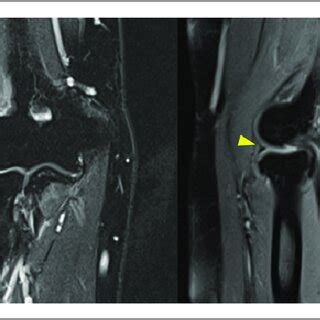 MRI demonstrated lesions of a patient who had lateral epicondylitis... | Download Scientific Diagram