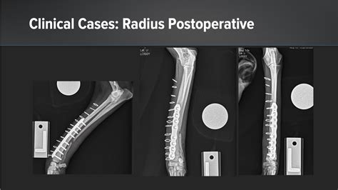 Arthrex OrthoLine Fracture System