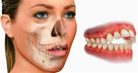 Maloclusion Dental Tipos Consecuencias Y Tratamiento Top Doctors