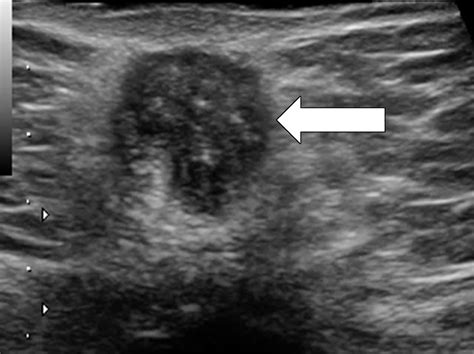 Atypical Sites Of Deeply Infiltrative Endometriosis Clinical Characteristics And Imaging