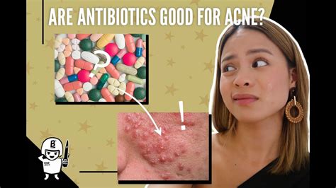 My Experience With Antibiotics For Acne Pros And Cons Youtube